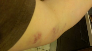 The bruises looked even uglier the day after